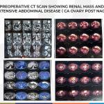 An interesting case of dual malignancy (CA ovary and RCC ) in 71-year-old female