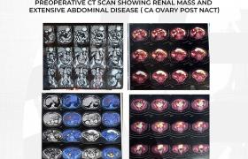 An interesting case of dual malignancy (CA ovary and RCC ) in 71-year-old female