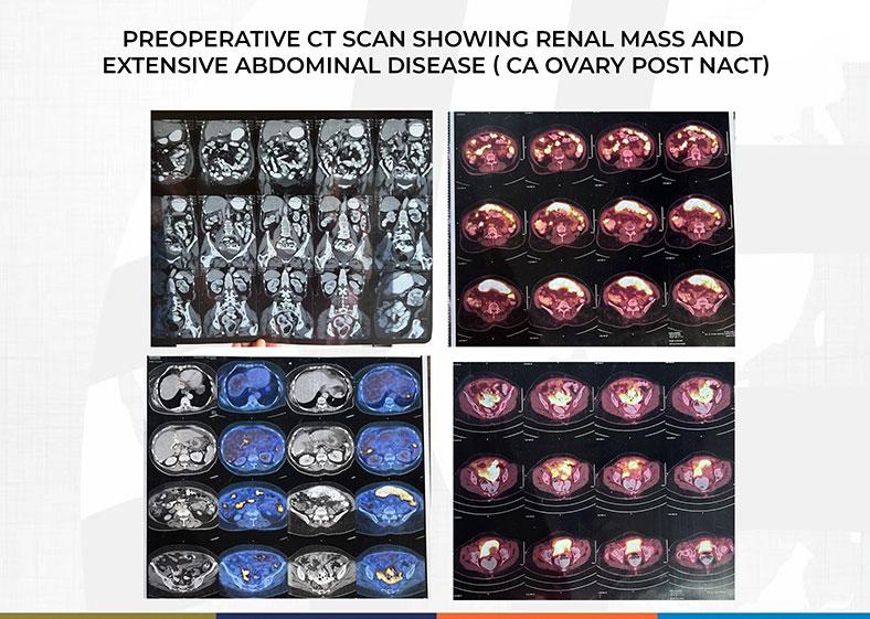 An interesting case of dual malignancy (CA ovary and RCC ) in 71-year-old female