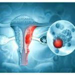 Raising Awareness: Understanding and Preventing Gynecologic Cancers