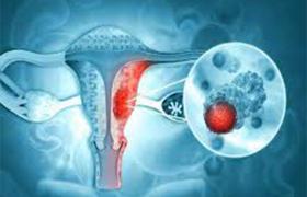 Raising Awareness: Understanding and Preventing Gynecologic Cancers