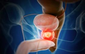 Comprehensive Guide to Prostate Cancer Treatment