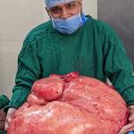 Record-Breaking Surgery: Successful Removal of 48 kg Non-Ovarian Tumor