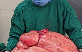 Record-Breaking Surgery: Successful Removal of 48 kg Non-Ovarian Tumor