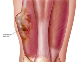 Symptoms of Soft Tissue Cancer